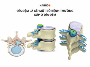 Đĩa đệm là gì? Một số bệnh thường gặp ở đĩa đệm