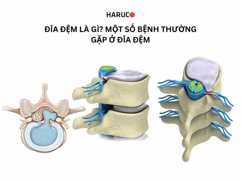 Đĩa đệm là gì? Một số bệnh thường gặp ở đĩa đệm