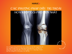 Tổng hợp các phương pháp điều trị thoái hóa khớp gối hiệu quả