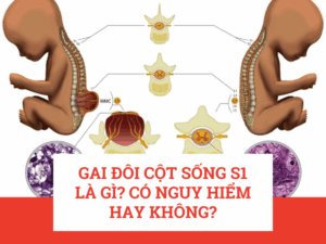 Gai đôi cột sống S1 là gì? Có nguy hiểm hay không?