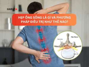 Hẹp ống sống là gì? Phương pháp điều trị như thế nào?