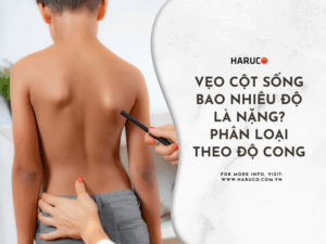 Vẹo cột sống bao nhiêu độ là nặng? Phân loại theo độ cong