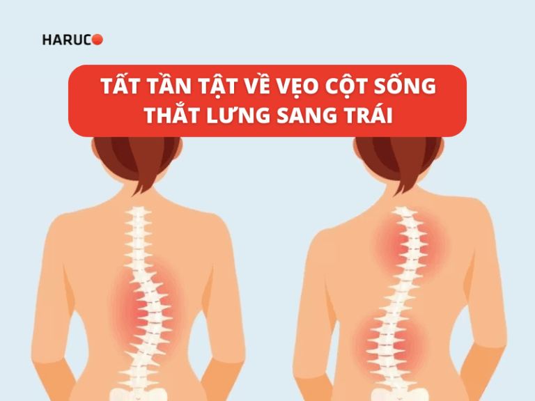 Tất tần tật về vẹo cột sống thắt lưng sang trái