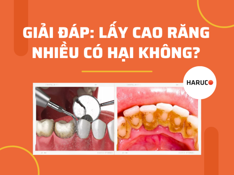 Lấy cao răng nhiều có hại không? Cần lưu ý gì để duy trì răng khỏe?