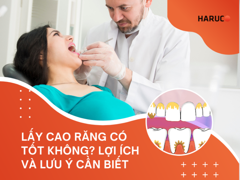 Lấy cao răng có tốt không? Lợi ích và lưu ý cần biết