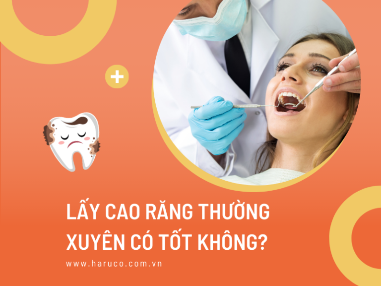 Lấy cao răng thường xuyên có tốt không? Cần lưu ý điều gì?