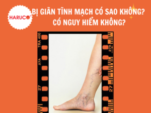 Bị giãn tĩnh mạch có sao không? Có nguy hiểm không?