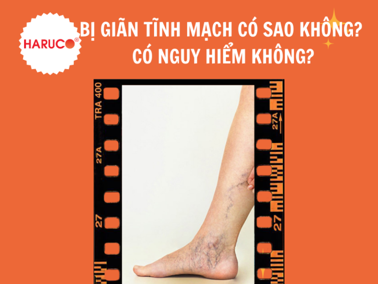 Bị giãn tĩnh mạch có sao không? Có nguy hiểm không?