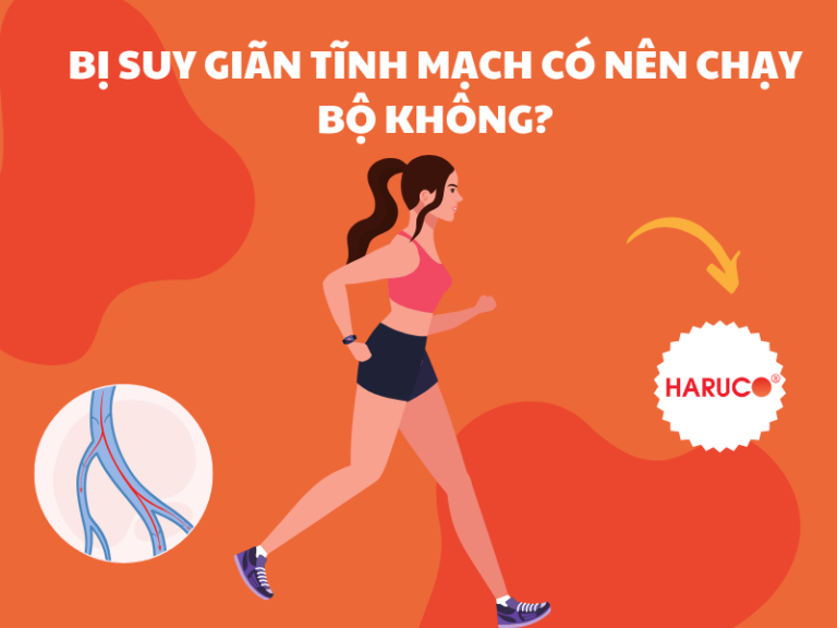 Bị suy giãn tĩnh mạch có nên chạy bộ không?