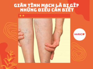 Giãn tĩnh mạch là bị gì? Những điều cần biết