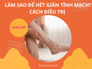 Làm sao để hết giãn tĩnh mạch? Cách điều trị 