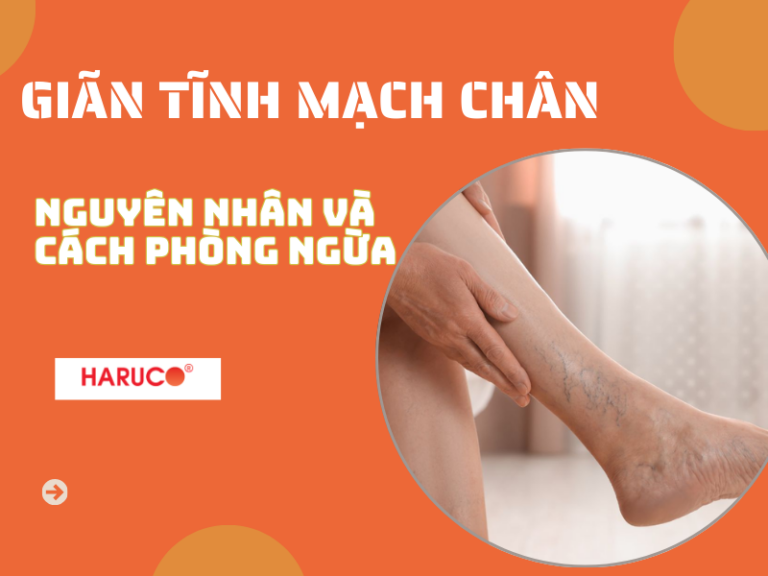 Lý do bị giãn tĩnh mạch chân: Nguyên nhân và cách phòng ngừa