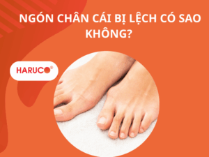 Ngón chân cái bị lệch có sao không? 