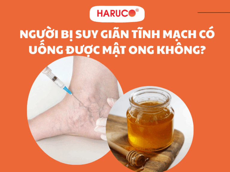 Người bị suy giãn tĩnh mạch có uống được mật ong không?