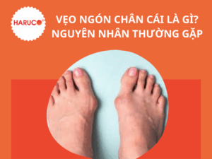 Vẹo ngón chân cái là gì? Nguyên nhân thường gặp 