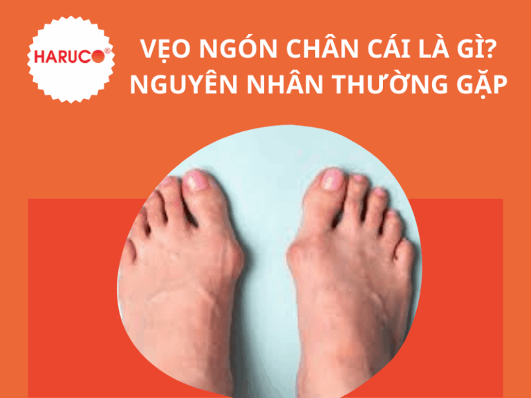 Vẹo ngón chân cái là gì? Nguyên nhân thường gặp 